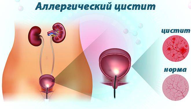 Алергічний цистит: симптоми і лікування