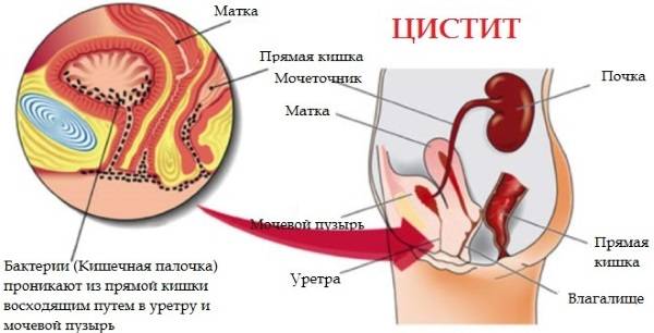 Антибіотик під час циститу у жінок швидкого список дії препаратів