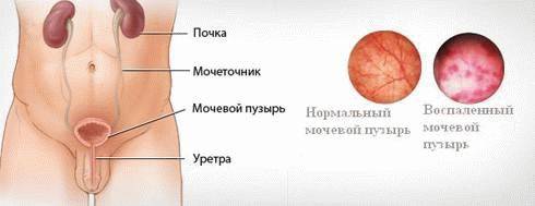 Антибіотики від циститу та уретриту у чоловіків