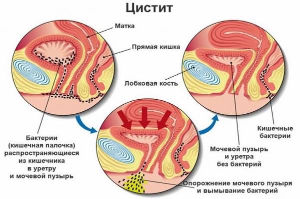 Буває кров у сечі при циститі Нирки