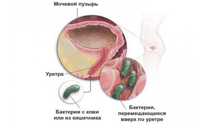 Через скільки починають діяти антибіотики при циститі