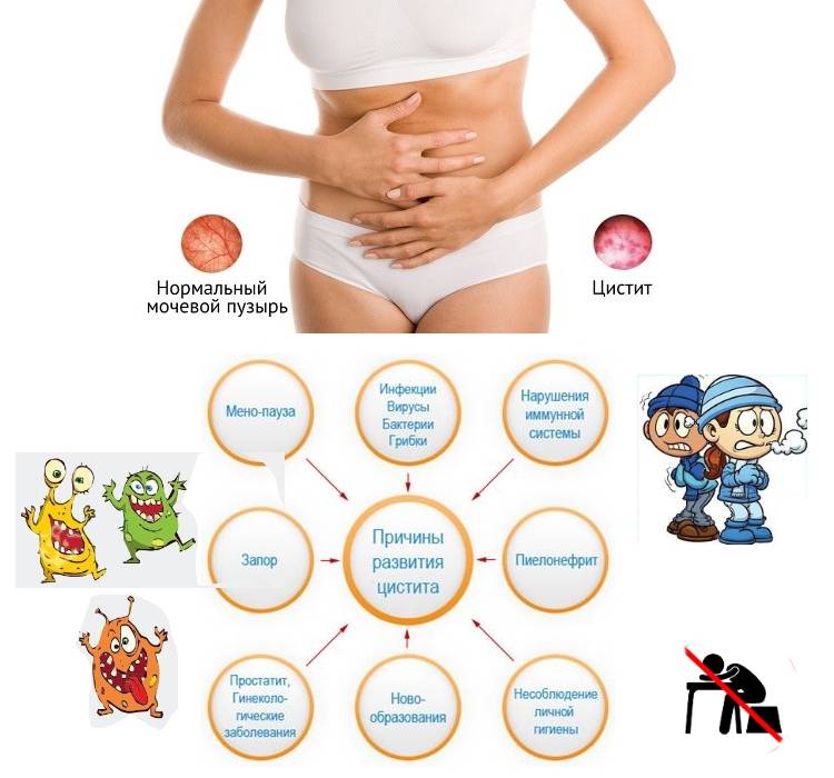 Чи можна вилікувати цистит не антибіотиками Чи можна вилікувати цистит не антибіотиками