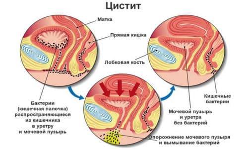 Чи можна завагітніти при хронічному циститі: впливає і на зачаття і вагітність 2019