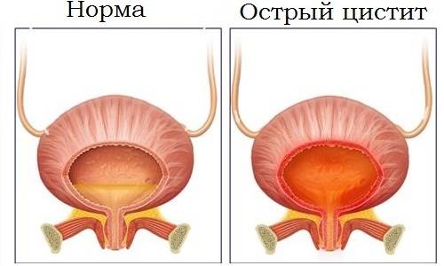 Чи можна займатися спортом при циститі Чи можна займатися спортом при циститі