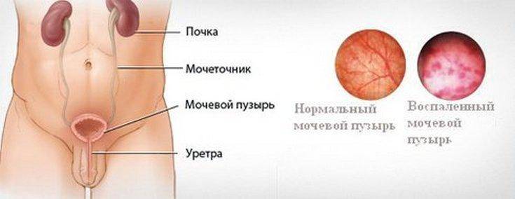 Чоловічий цистит симптоми та ефективне лікування Чоловічий цистит симптоми та ефективне лікування