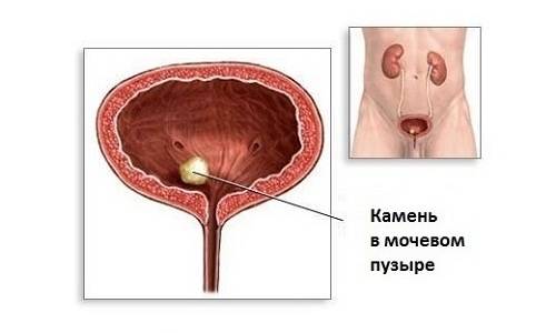 Чому цистит не проходить