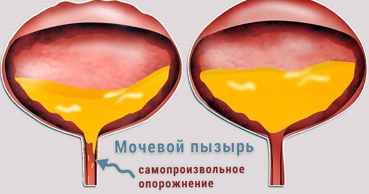 Чому при циститі нетримання сечі