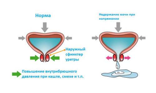 Чому при циститі нетримання сечі