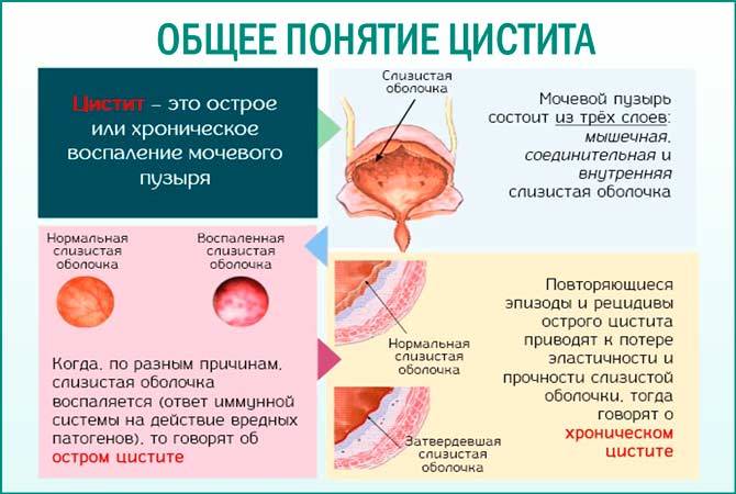 Цистит і гінекологічні захворювання Лікування потнеции Цистит і гінекологічні захворювання Лікування потнеции