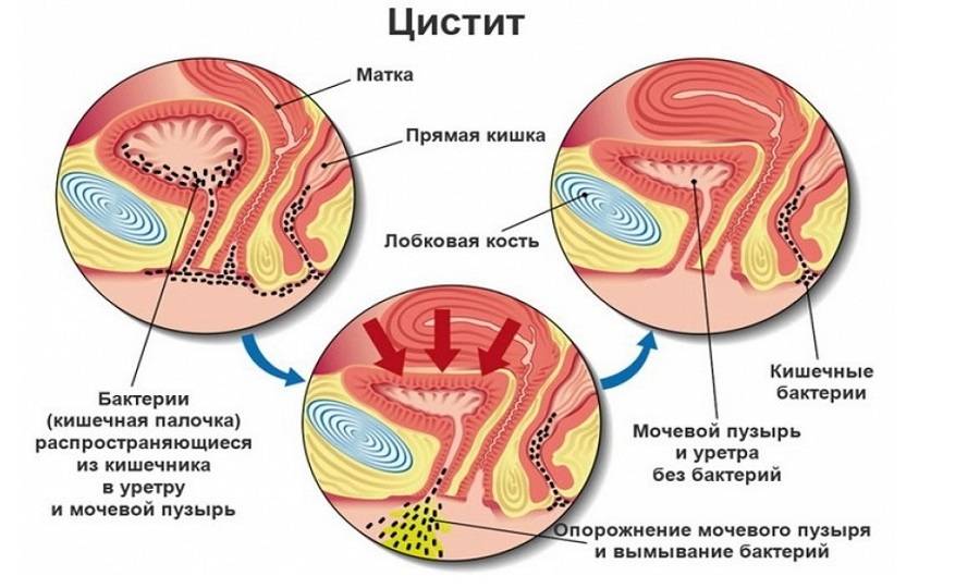 Цистит кишкова паличка в сечі