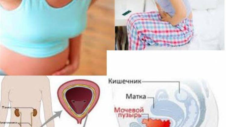Цистит кишкова паличка в сечі
