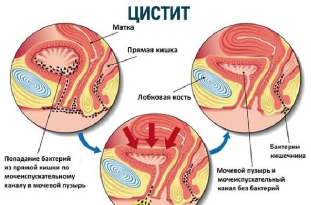 Цистит кишкова паличка в сечі