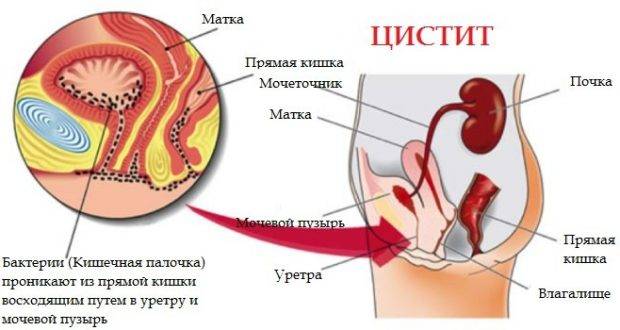 Цистит кишкова паличка в сечі