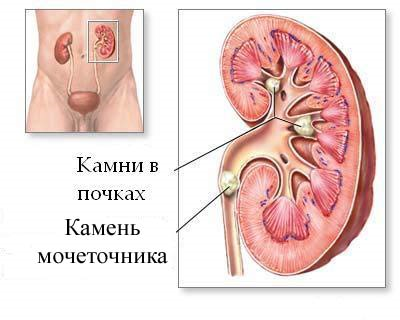 Цистит монурал і монурель – Цистит