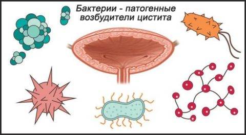 Цистит і інтимна близькість Цистит і інтимна близькість