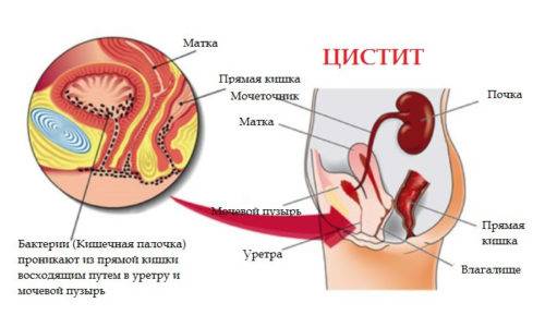 Цистит під час місячних (перед, після, одночасно): причини, як лікувати, вплив