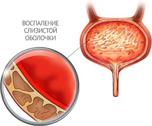 Цистит після інтимної близькості. Причини і лікування циститу після сексу