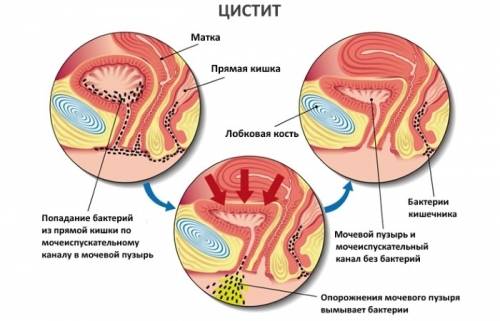 Цистит після інтимної близькості. Причини і лікування циститу після сексу Цистит після інтимної близькості. Причини і лікування циститу після сексу