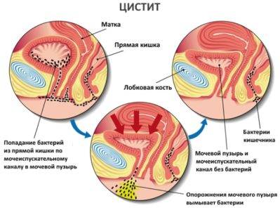 Цистит після сексу, посткоїтальний цистит