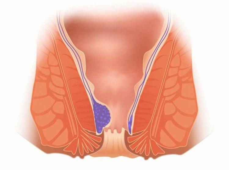 Цистит при грудному вигодовуванні причини виникнення і лікування