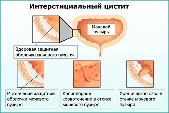 Цистит при грудному вигодовуванні як лікувати правильно