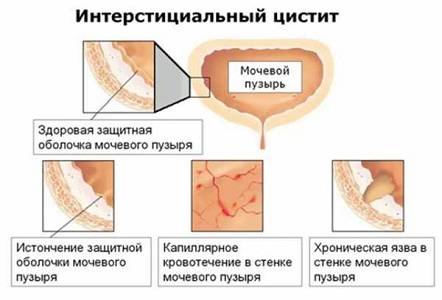 Цистит при клімаксі у жінок: симптоми і лікування, діагностика та заходи профілактики