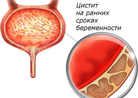 Цистит при вагітності на ранніх термінах температура підвищена що робити