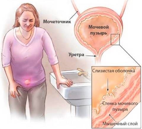 Цистит при вагітності: перші симптоми і методи лікування