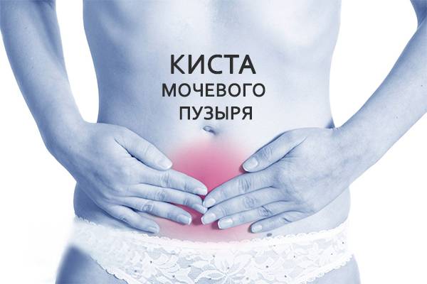 Цистит сечового міхура: симптоми і лікування