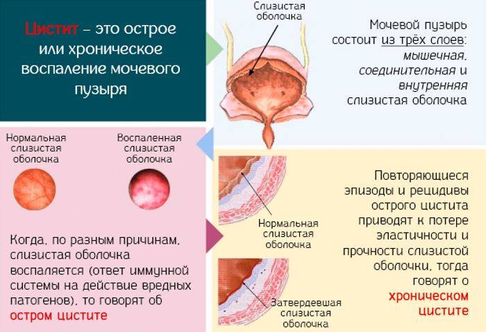 Цистит у чоловіків — лікування, харчування