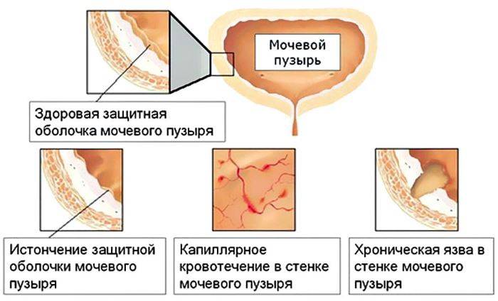 Цистит у чоловіків — лікування, харчування