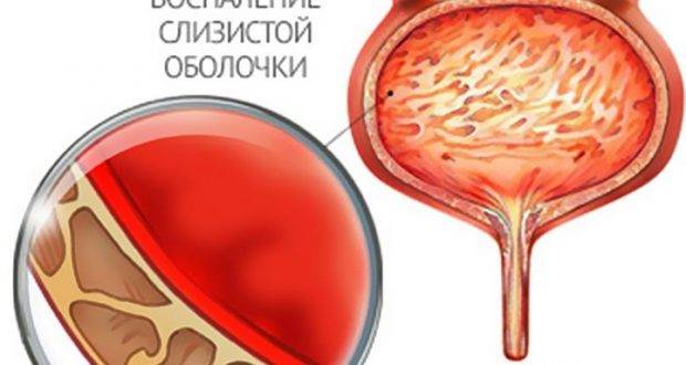 Цистит у дітей: причини, симптоми і лікування
