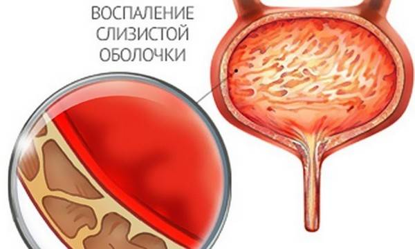 Цистит у дітей: причини, симптоми і лікування Цистит у дітей: причини, симптоми і лікування
