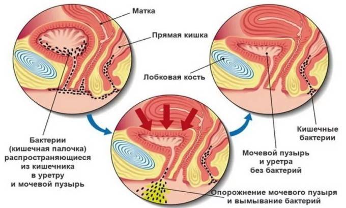 Цистит у дітей симптоми і лікування циститу у ребнка Цистит у дітей симптоми і лікування циститу у ребнка