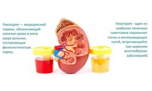 Цистит у дітей симптоми і лікування циститу у ребнка Цистит у дітей симптоми і лікування циститу у ребнка