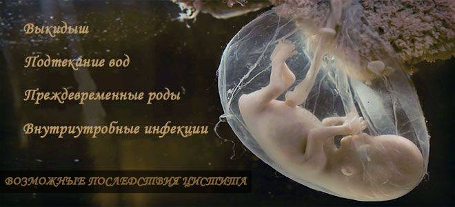 Цистит у другому триместрі вагітності
