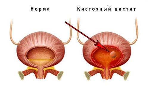 Цистит у хлопчиків в 3,5,7,8 і 9 років Цистит у хлопчиків в 3,5,7,8 і 9 років
