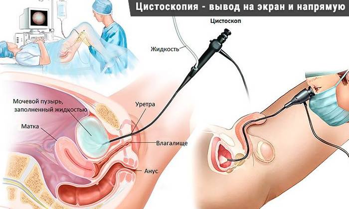Цистит у першому триместрі вагітності Цистит у першому триместрі вагітності