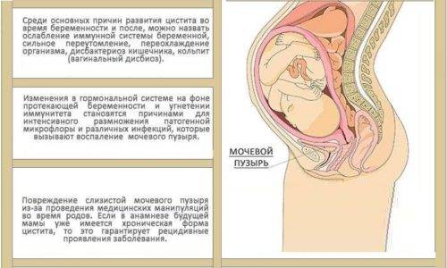 Цистит у першому триместрі вагітності Цистит у першому триместрі вагітності