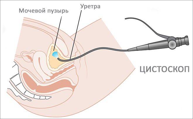 Цистит у жінок – причини, симптоми, діагностика та лікування Цистит у жінок – причини, симптоми, діагностика та лікування