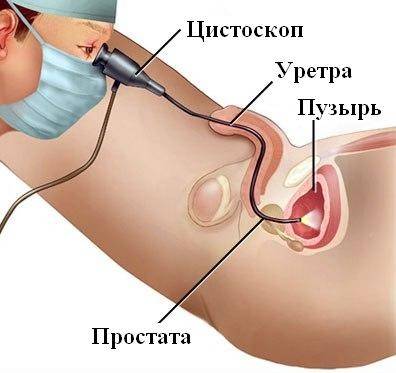 Цистит у жінок – причини, симптоми, діагностика та лікування Цистит у жінок – причини, симптоми, діагностика та лікування