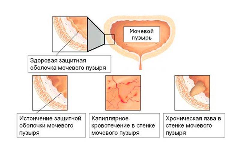 Цистит у жінок – причини, симптоми, діагностика та лікування
