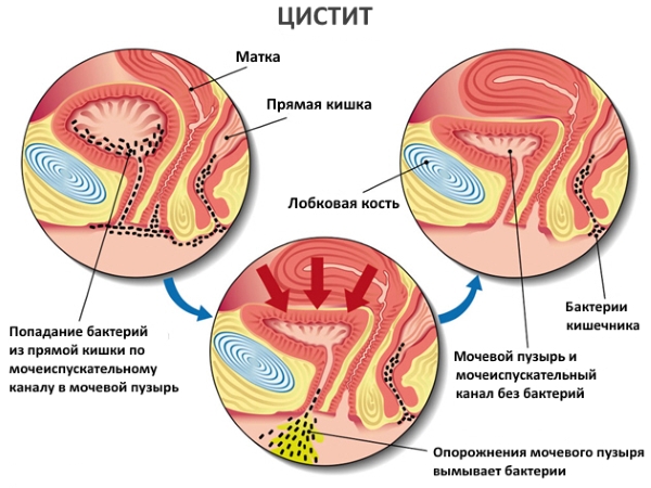 Цистит у жінок симптоми і лікування в домашніх умовах, як і чим лікувати захворювання, як швидко зняти напад циститу. Цистит у жінок симптоми і лікування в домашніх умовах, як і чим лікувати захворювання, як швидко зняти напад циститу.