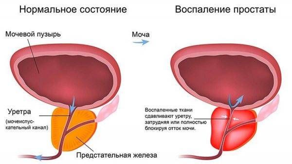 Цистит-запалення сечового міхура