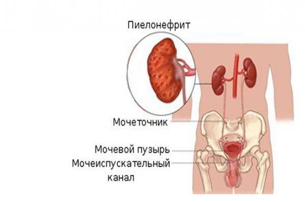 Цистит-запалення сечового міхура Цистит-запалення сечового міхура