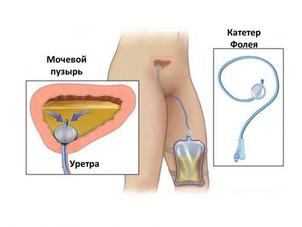 Цистит-запалення сечового міхура
