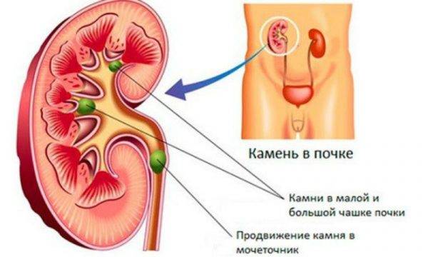 Цистит-запалення сечового міхура