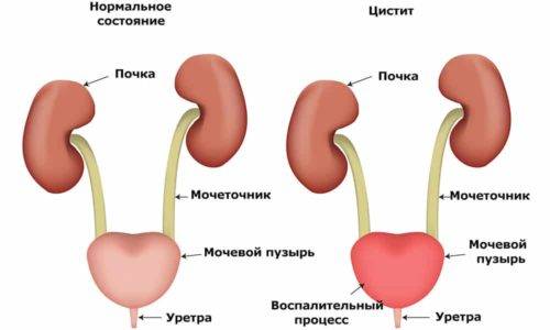 Цистит заразний чи ні – Все про урології Цистит заразний чи ні – Все про урології