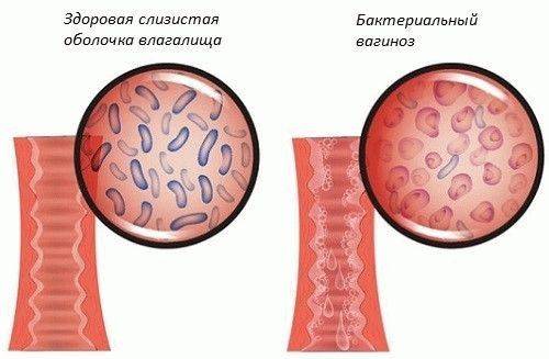 До якого лікаря звертатися при циститі жінці