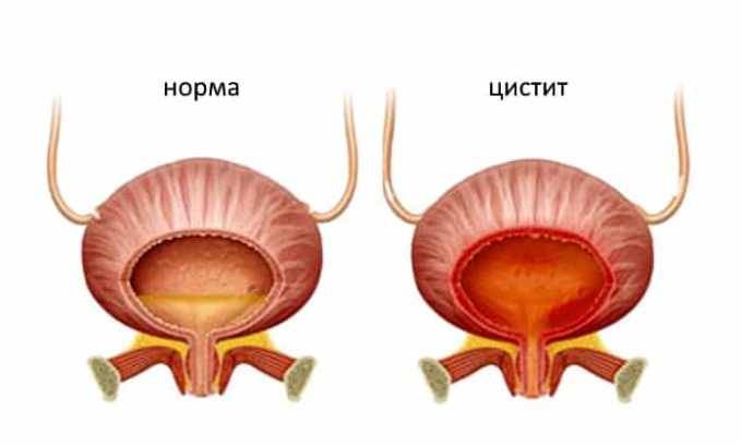 Допомагає при циститі бруснивер?